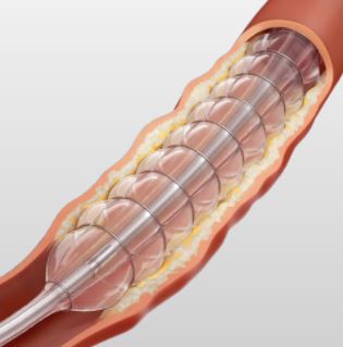 کاتتر بالون نیتینول PTA